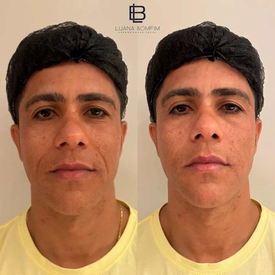 Antes e depois de harmonização do bigode chinês masculino — Dra. Luana Bomfim, Aracaju