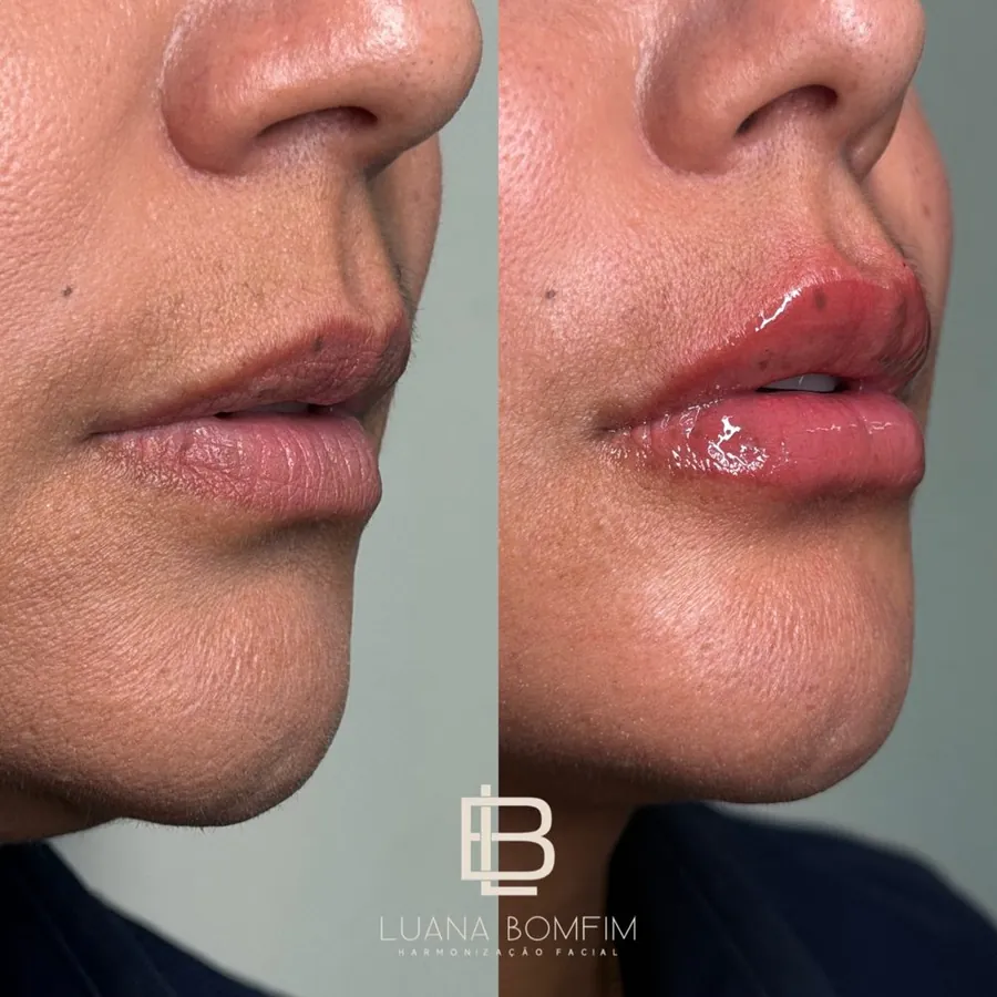 Antes e depois de preenchimento labial com definição e contorno — Dra. Luana Bomfim, Aracaju