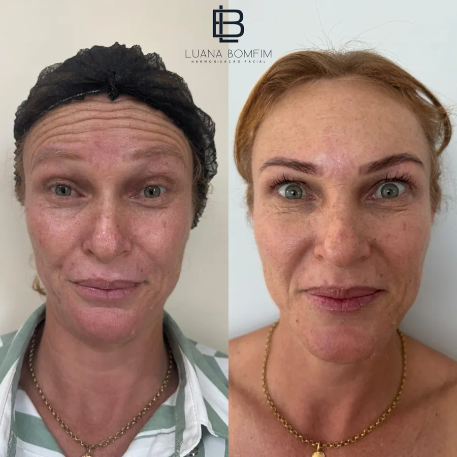 Antes e depois de aplicação de toxina botulínica em linhas da testa — Dra. Luana Bomfim, Aracaju
