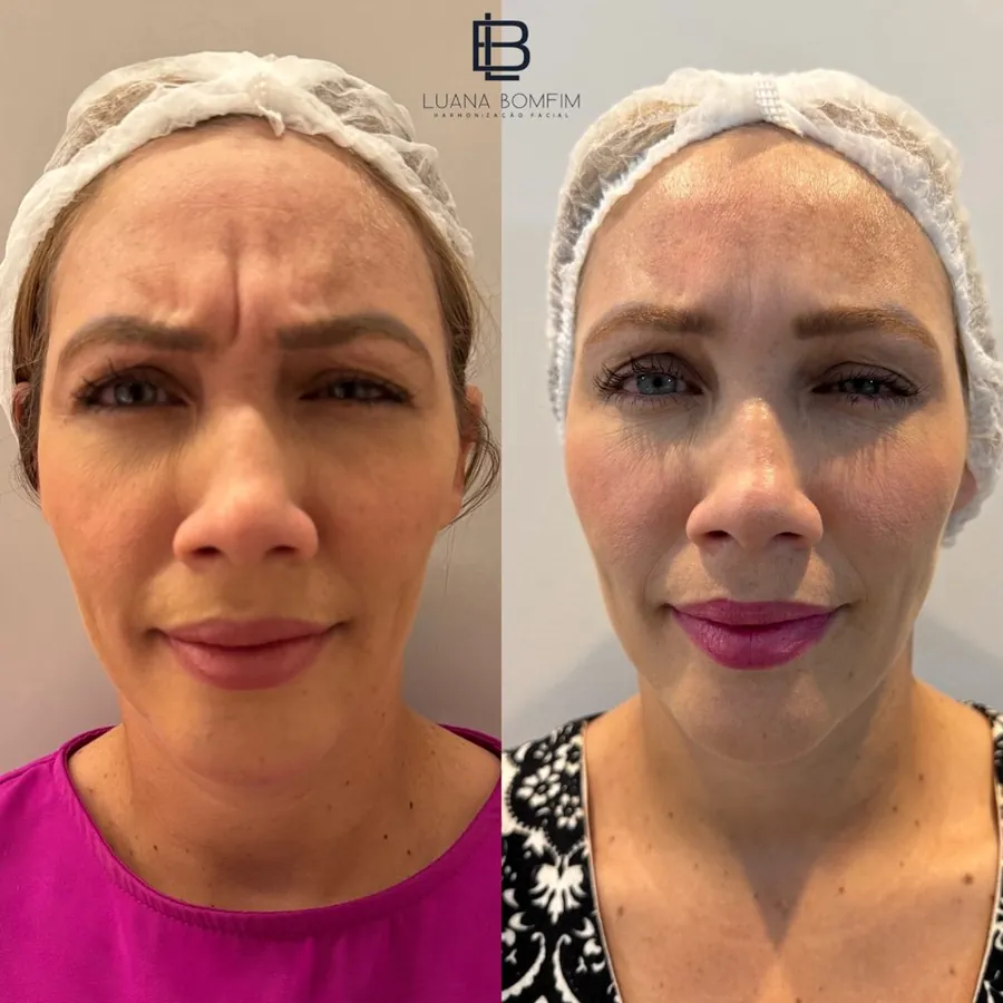 Antes e depois de toxina botulínica para linhas de expressão glabelares — Dra. Luana Bomfim, Aracaju